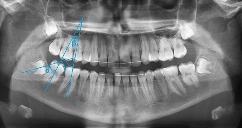 Figuur 2: Meting van de inclinatiehoeken van mandibulaire molaren.  Hoek α is de hoek tussen de tweede en derde kies of molaar,  hoek β is de hoek tussen de eerste en tweede molaar en  hoek γ is de hoek tussen de eerste en derde molaar.